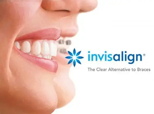 Close-up of Invisalign aligners being applied - Clear braces treatment