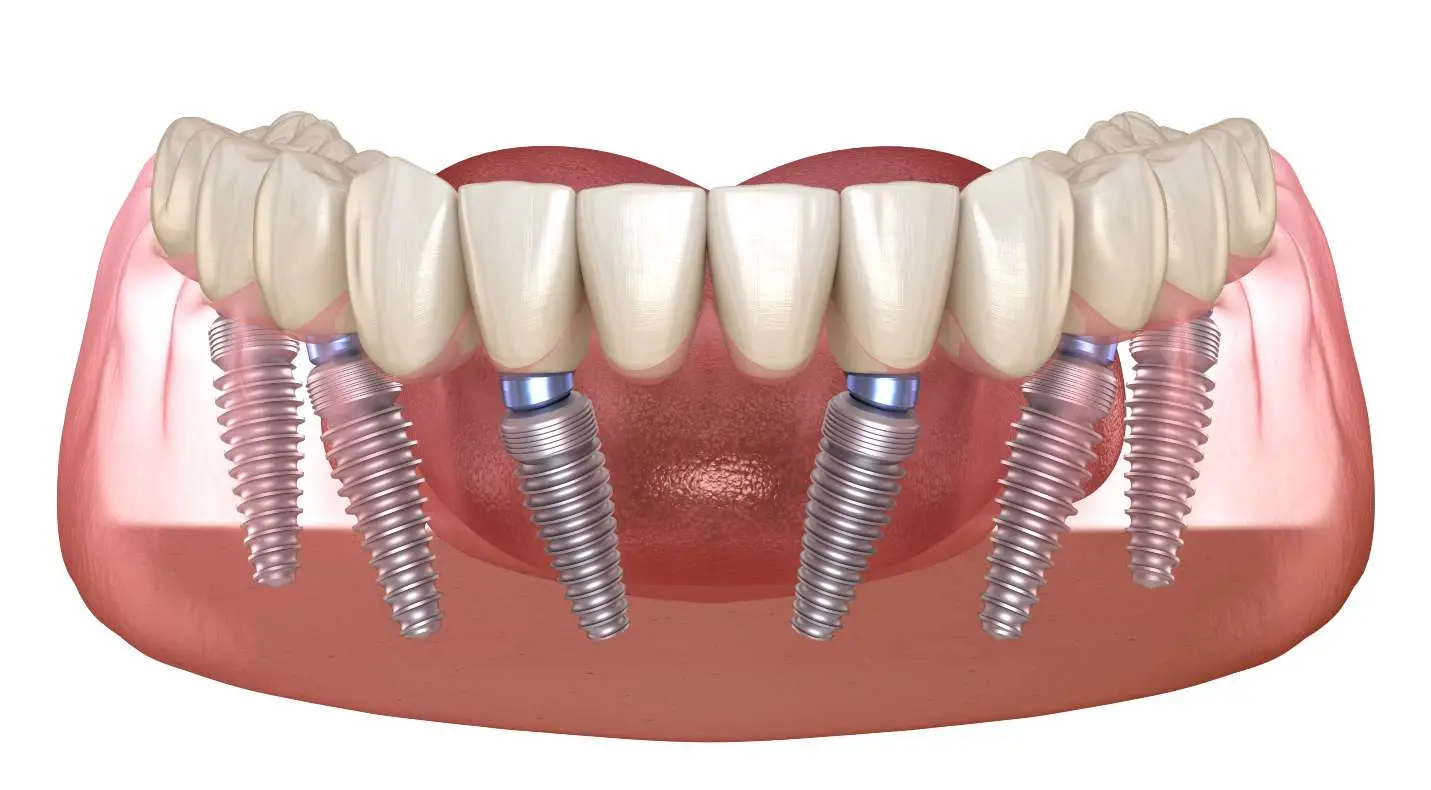 Wisdom tooth extraction procedure