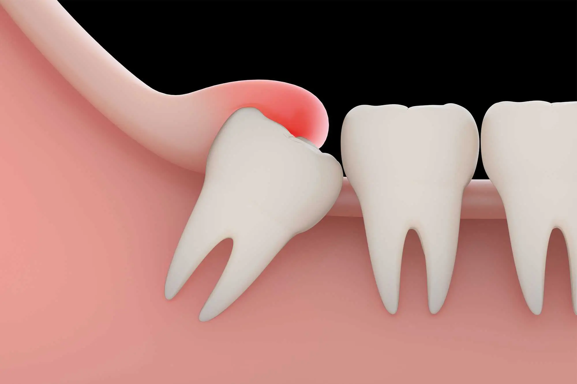Bone grafting procedure for dental implants