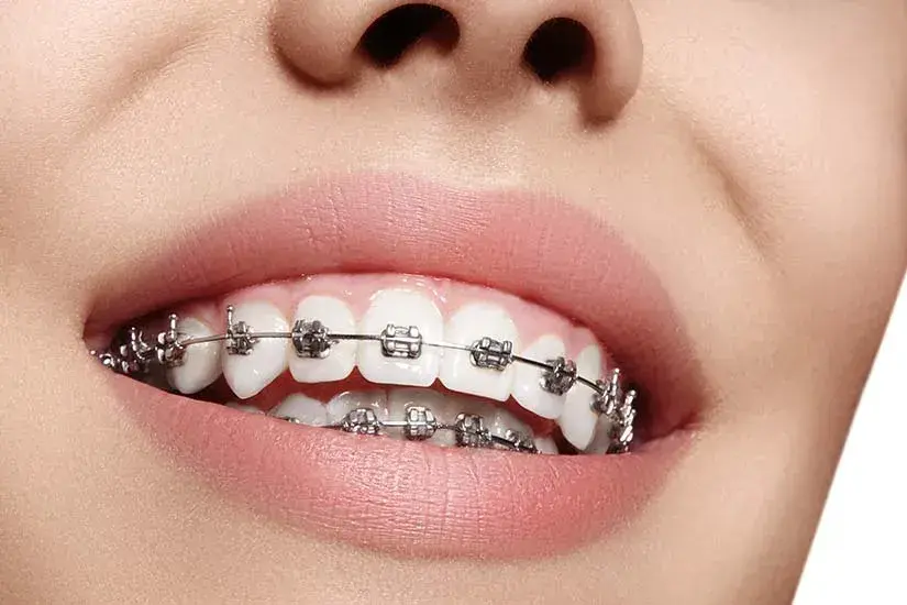 Patient smiling with Invisalign clear aligners