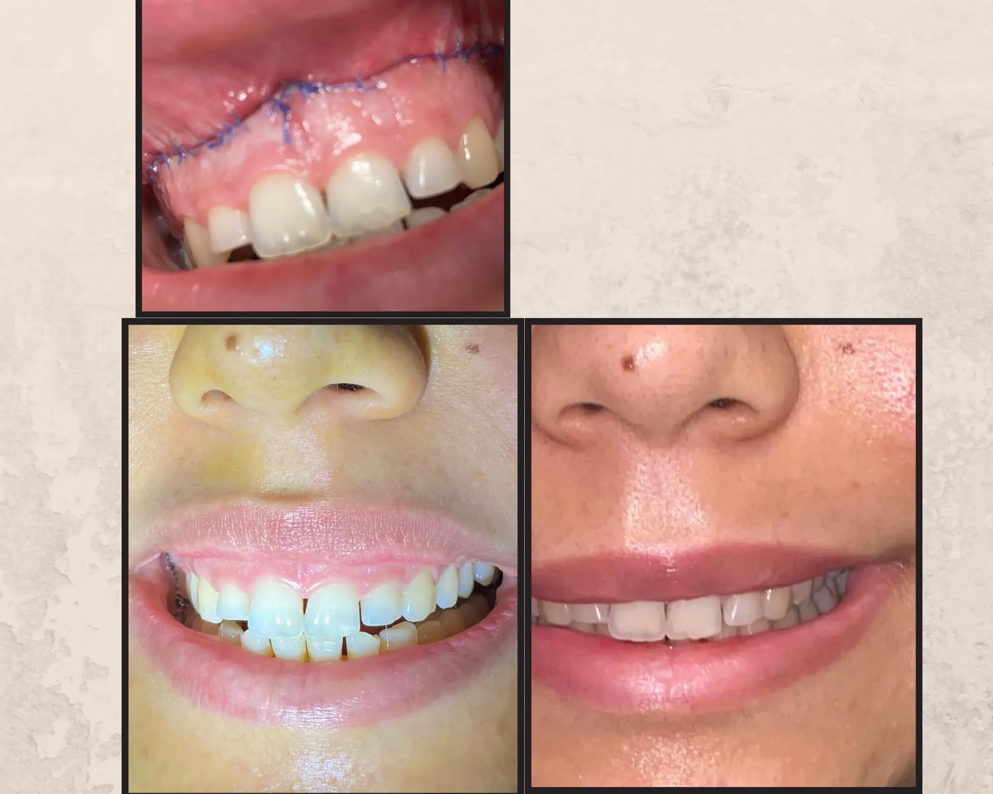 Dental tools used for periodontal treatment