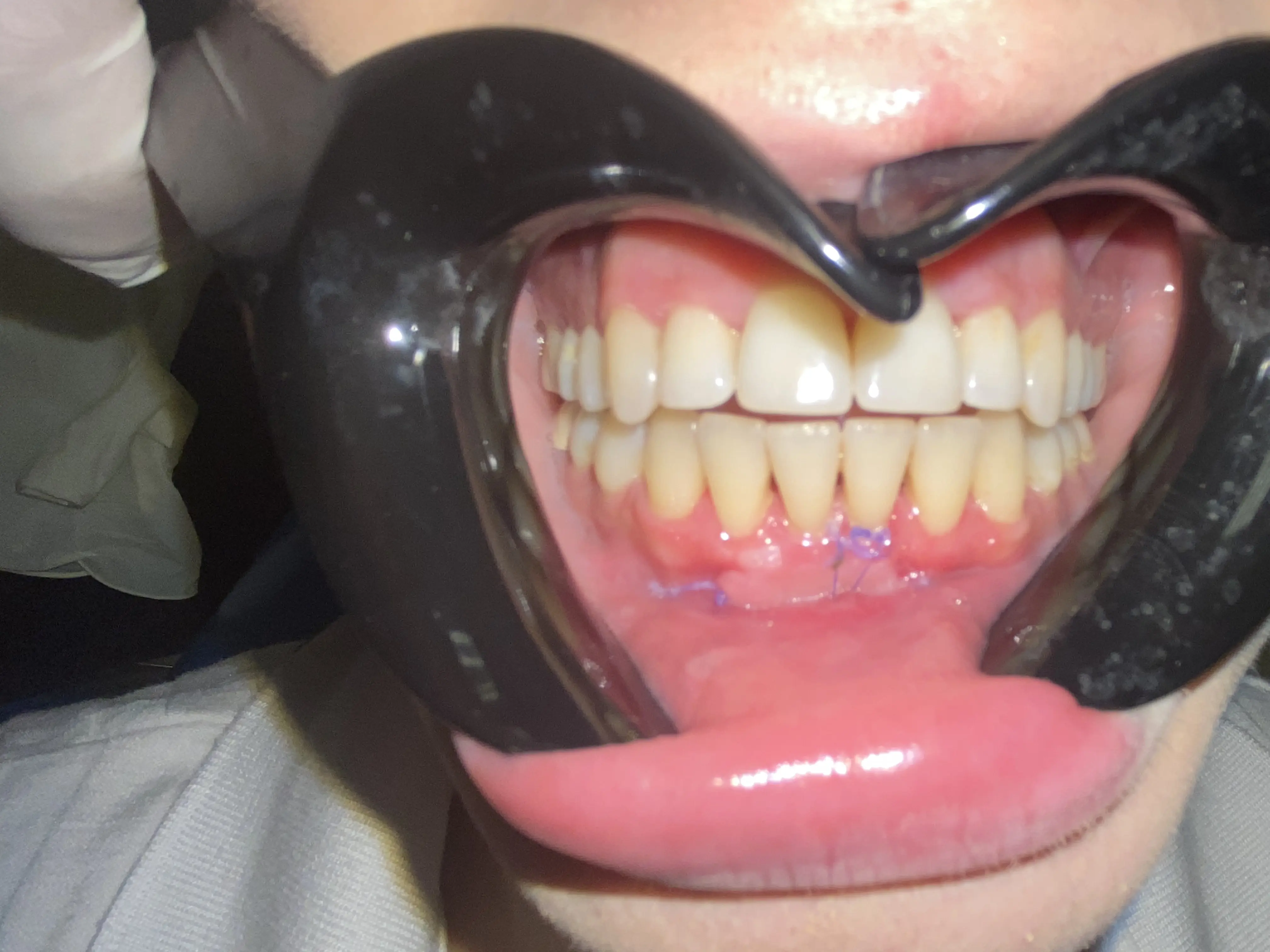 Healthy gums after periodontal treatment