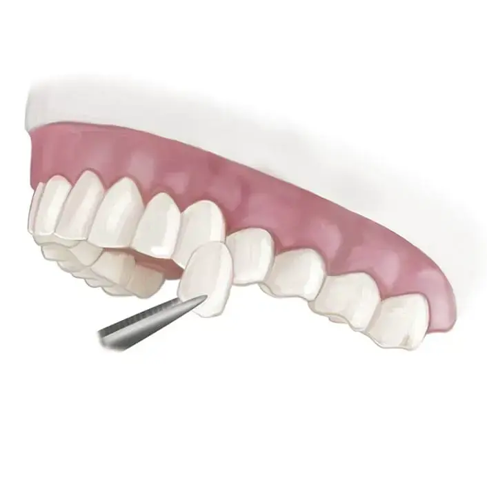 Dentist fitting a dental bridge