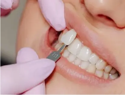Lazerle Diş Beyazlatma - Yayla Dental Akademi Diş Polilklinİği Bahçelievler İstanbul