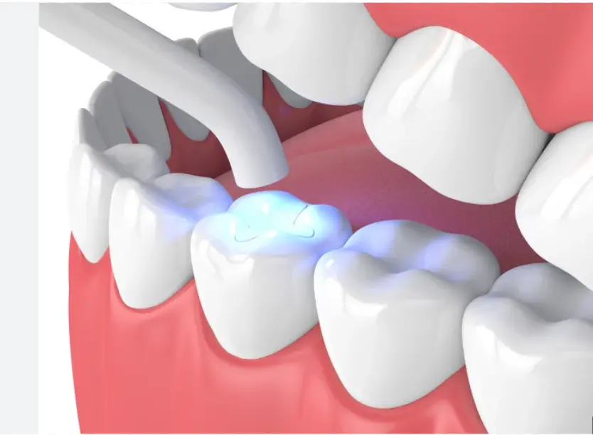 Dentist applying a dental crown at Yayla Dental Akademi Istanbul
